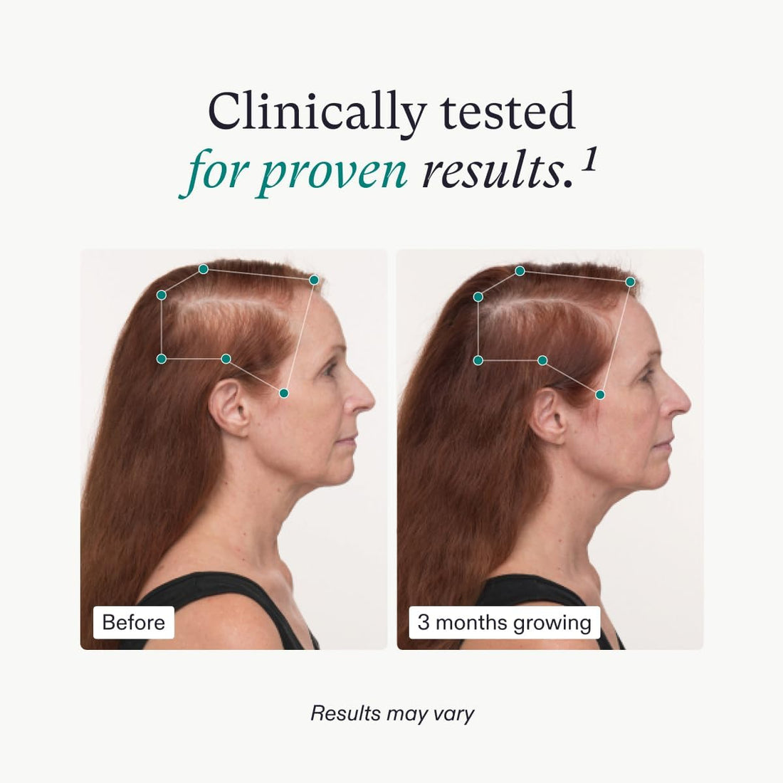 NUTRAFOL-  Experience Hair Growth in 3-6 months!